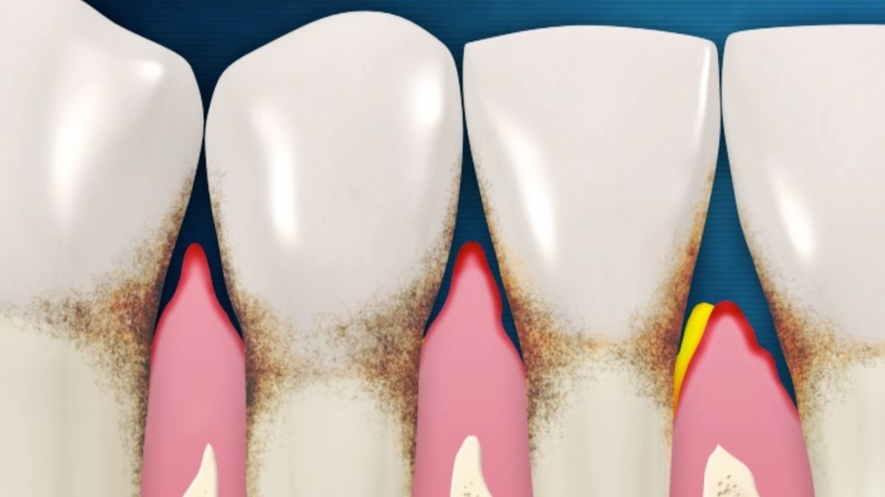An Overview of Gum Disease Video Thumbnail