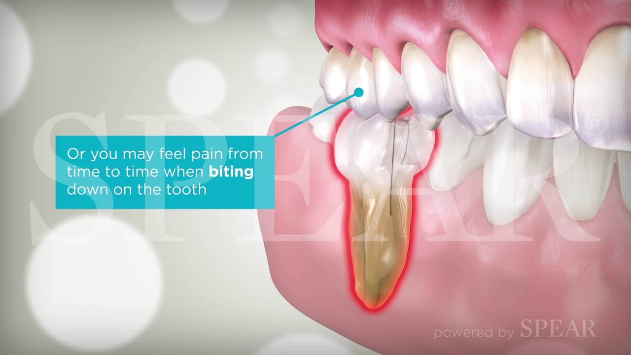 Preview of Cracked Teeth Waiting Room Video Video Thumbnail