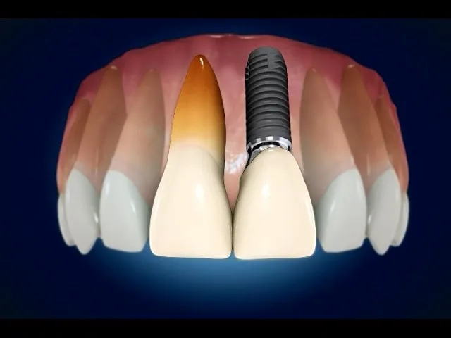 Restorative Dentistry Single Tooth Loss What is an Implant Video Thumbnail