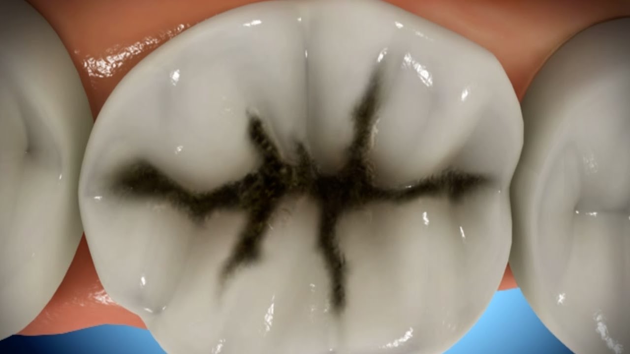 Understanding Adult Caries Video Thumbnail