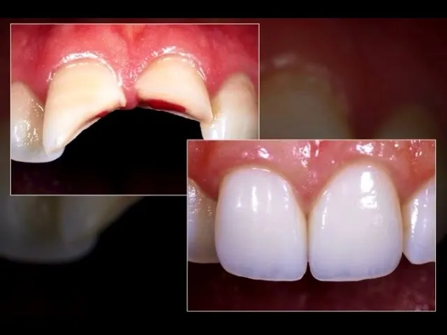 Restorative Dentistry Explanation of Crowns and Broken Teeth Video Thumbnail