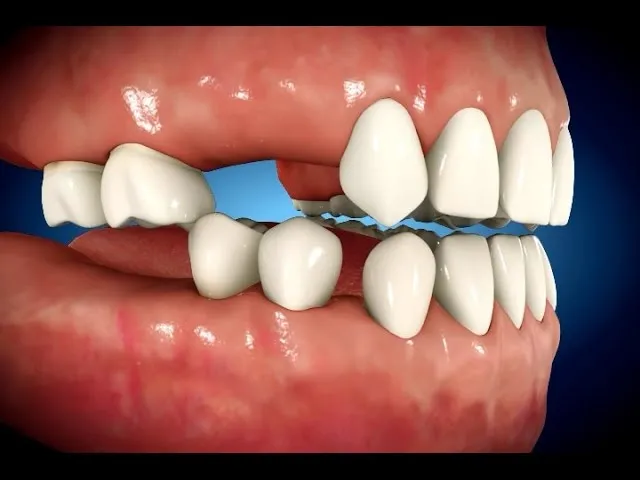 Multiple Tooth Loss Drifting Malocclusion Video Thumbnail
