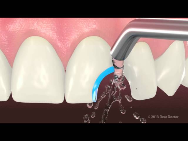 Cosmetic Bonding Video Thumbnail