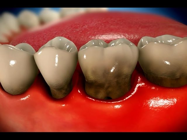 Stages of Periodontal Disease Gum Recession Video Thumbnail