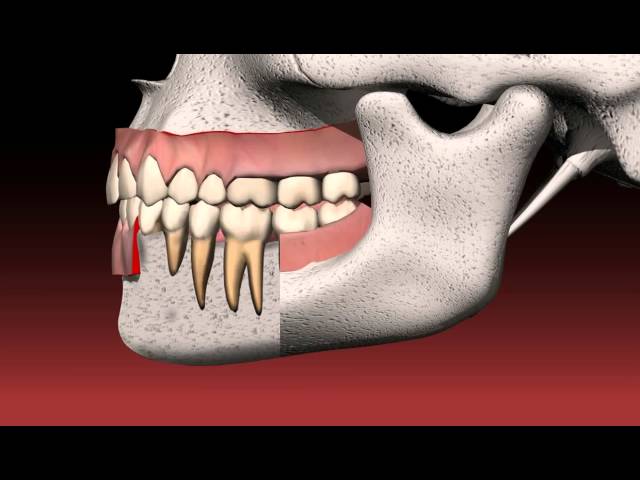 What is a Dental Bridge Video Thumbnail